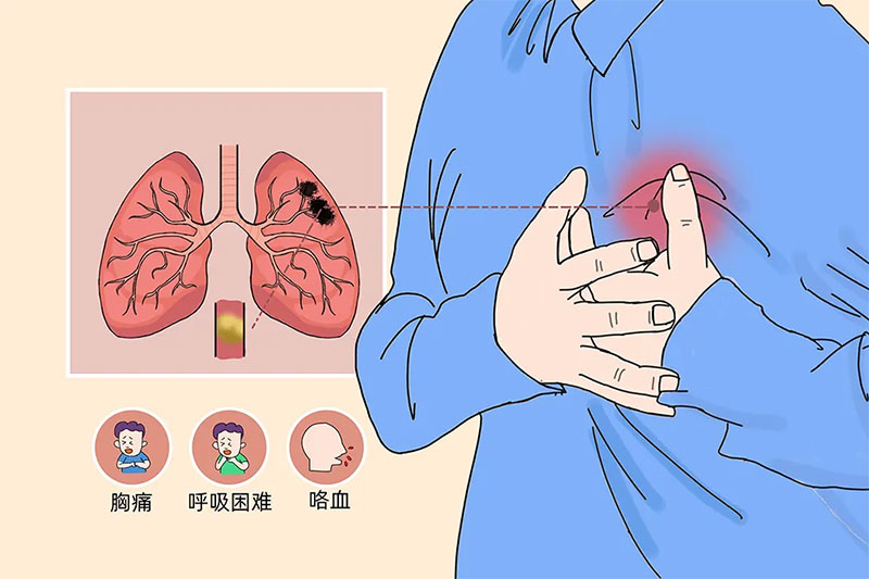 警惕“沉默的杀手”——静脉血栓栓塞症（VTE）健康宣教