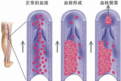 警惕“沉默的杀手”——静脉血栓栓塞症（VTE）健康宣教